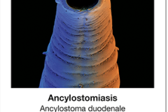 Seuchen2_01_Ancylostomiasis